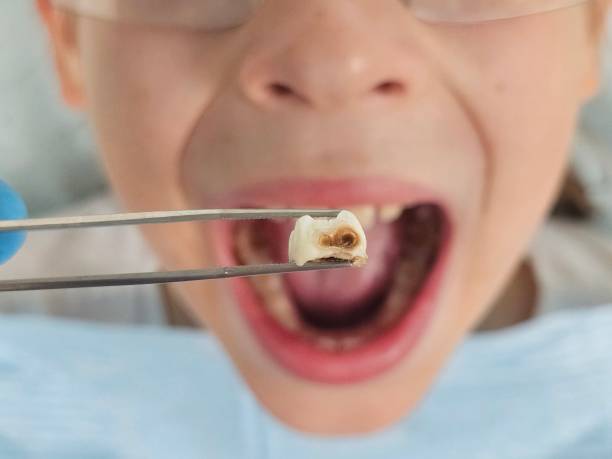 Best Dental Abscess Treatment in Henryville, IN